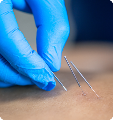 Acupuntura
